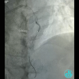 导丝怎么扩真怪！急性心梗前降支导丝通过顺利，球囊扩张后导丝移位很多！不在原来的血管腔！_https://www.jmylbn.com_新闻资讯_第3张