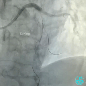 导丝怎么扩真怪！急性心梗前降支导丝通过顺利，球囊扩张后导丝移位很多！不在原来的血管腔！_https://www.jmylbn.com_新闻资讯_第9张