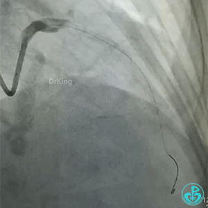 导丝怎么扩真怪！急性心梗前降支导丝通过顺利，球囊扩张后导丝移位很多！不在原来的血管腔！_https://www.jmylbn.com_新闻资讯_第5张