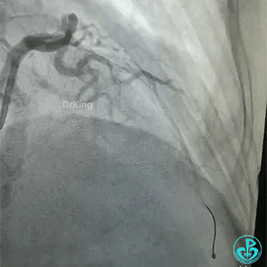 导丝怎么扩真怪！急性心梗前降支导丝通过顺利，球囊扩张后导丝移位很多！不在原来的血管腔！_https://www.jmylbn.com_新闻资讯_第7张