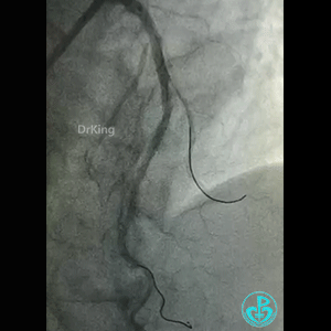 导丝怎么扩真怪！急性心梗前降支导丝通过顺利，球囊扩张后导丝移位很多！不在原来的血管腔！_https://www.jmylbn.com_新闻资讯_第12张