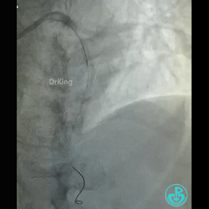 导丝怎么扩真怪！急性心梗前降支导丝通过顺利，球囊扩张后导丝移位很多！不在原来的血管腔！_https://www.jmylbn.com_新闻资讯_第4张