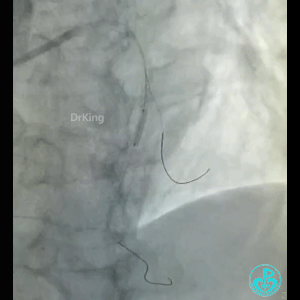 导丝怎么扩真怪！急性心梗前降支导丝通过顺利，球囊扩张后导丝移位很多！不在原来的血管腔！_https://www.jmylbn.com_新闻资讯_第11张