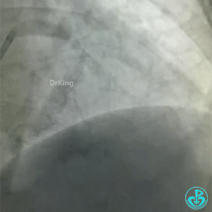 导丝怎么扩真怪！急性心梗前降支导丝通过顺利，球囊扩张后导丝移位很多！不在原来的血管腔！_https://www.jmylbn.com_新闻资讯_第1张