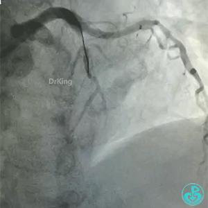 导丝怎么扩真怪！急性心梗前降支导丝通过顺利，球囊扩张后导丝移位很多！不在原来的血管腔！_https://www.jmylbn.com_新闻资讯_第2张