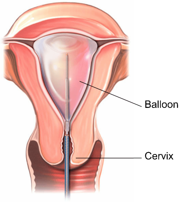 子宫球囊支架怎么取宫腔镜术后放置球囊的用处_https://www.jmylbn.com_新闻资讯_第2张