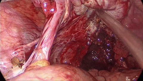 吸引器怎么使用手术兵器谱篇——使用腹腔镜下那根“棍”的招式攻略_https://www.jmylbn.com_新闻资讯_第6张