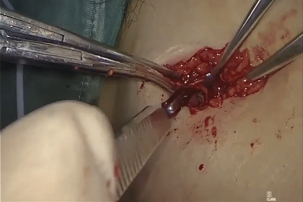 为什么不用切口保护套龚瑶专栏 ｜ 切口保护套在腹腔镜术中的 5 大妙用_https://www.jmylbn.com_新闻资讯_第9张