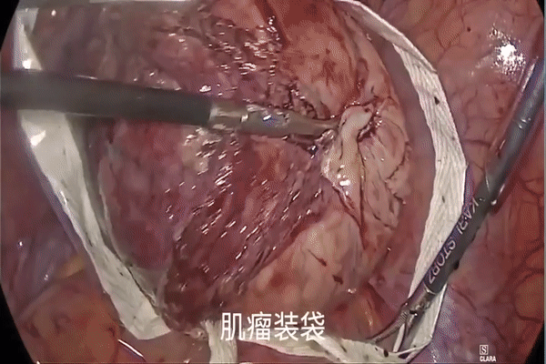 为什么不用切口保护套龚瑶专栏 ｜ 切口保护套在腹腔镜术中的 5 大妙用_https://www.jmylbn.com_新闻资讯_第8张