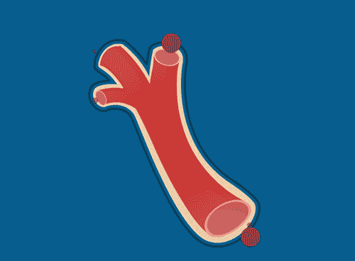 血管「堵」的是什么？骗子和医生分别是这么解释的