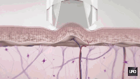 30分钟法国LPG，肌肤醇享初恋般的怦然心动!