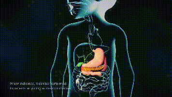 取石球囊怎么取石不开刀就能取胆管结石的方法，你了解吗？ ｜ 一页手册 · 协和八_https://www.jmylbn.com_新闻资讯_第4张