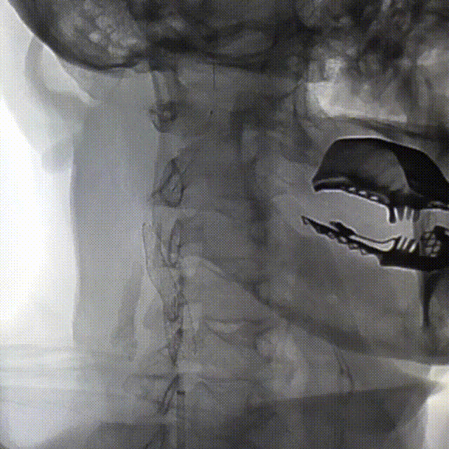 动脉长鞘怎么置入桡路大腔，超薄无伤 ｜ EasyMax™ Pro长鞘经桡入路辅助行颈内动脉支架植入术_https://www.jmylbn.com_新闻资讯_第11张
