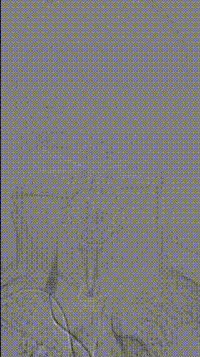 动脉长鞘怎么置入桡路大腔，超薄无伤 ｜ EasyMax™ Pro长鞘经桡入路辅助行颈内动脉支架植入术_https://www.jmylbn.com_新闻资讯_第2张