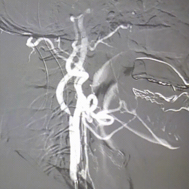 动脉长鞘怎么置入桡路大腔，超薄无伤 ｜ EasyMax™ Pro长鞘经桡入路辅助行颈内动脉支架植入术_https://www.jmylbn.com_新闻资讯_第7张