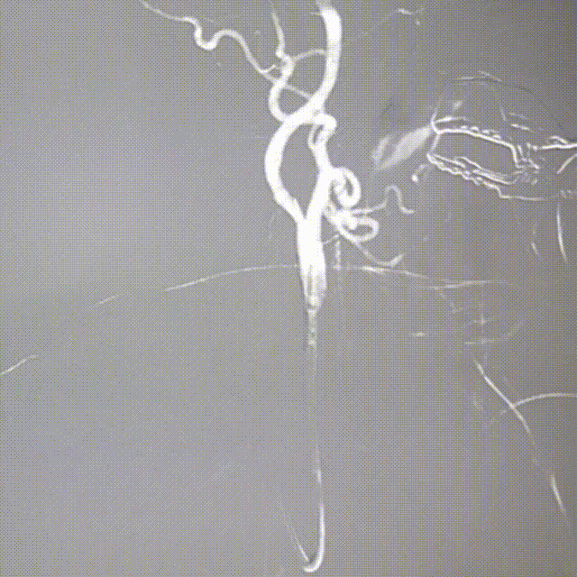 动脉长鞘怎么置入桡路大腔，超薄无伤 ｜ EasyMax™ Pro长鞘经桡入路辅助行颈内动脉支架植入术_https://www.jmylbn.com_新闻资讯_第9张