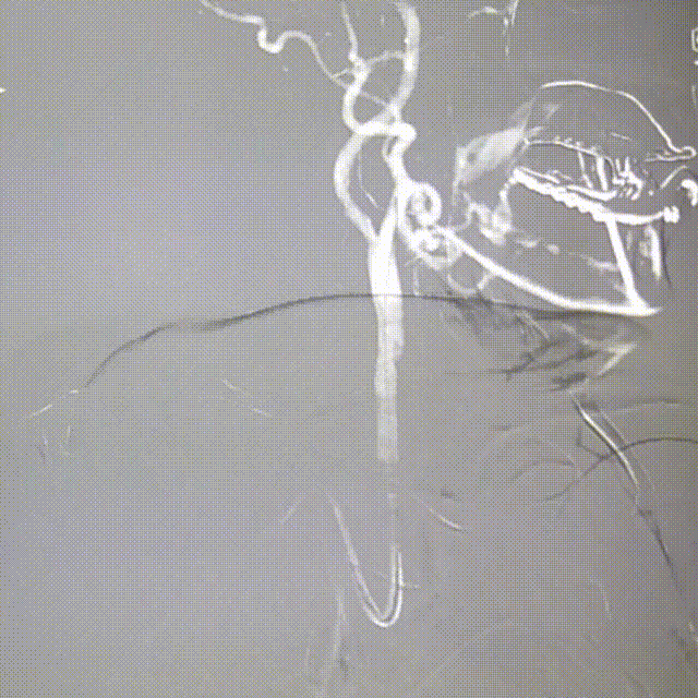 动脉长鞘怎么置入桡路大腔，超薄无伤 ｜ EasyMax™ Pro长鞘经桡入路辅助行颈内动脉支架植入术_https://www.jmylbn.com_新闻资讯_第8张