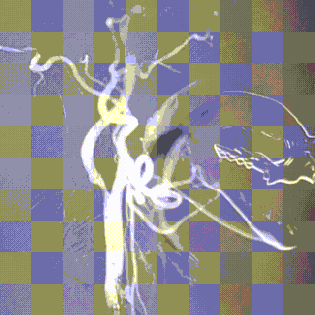 动脉长鞘怎么置入桡路大腔，超薄无伤 ｜ EasyMax™ Pro长鞘经桡入路辅助行颈内动脉支架植入术_https://www.jmylbn.com_新闻资讯_第6张