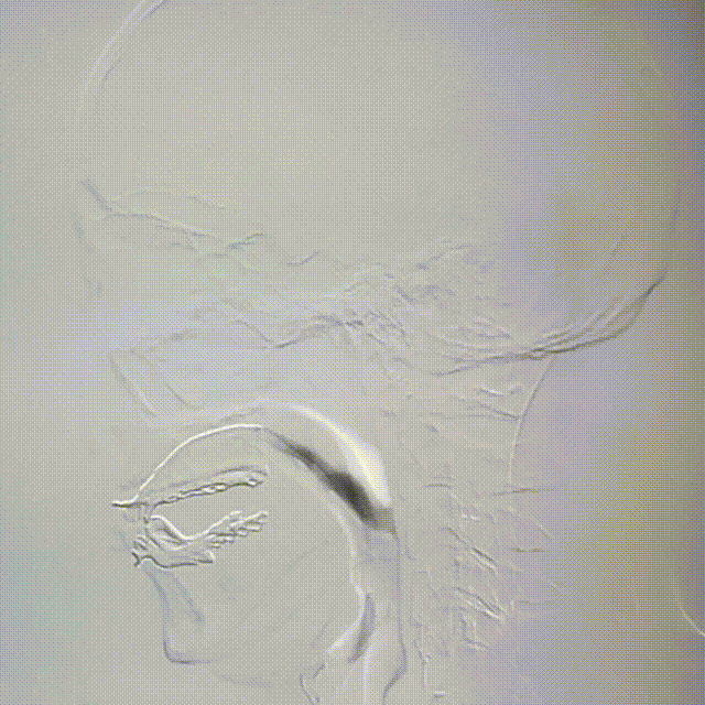 动脉长鞘怎么置入桡路大腔，超薄无伤 ｜ EasyMax™ Pro长鞘经桡入路辅助行颈内动脉支架植入术_https://www.jmylbn.com_新闻资讯_第10张