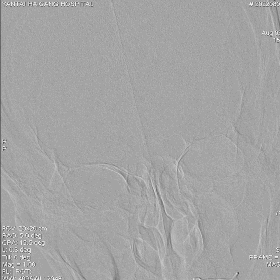 导丝怎么扩【载药时代 球扩天下】NOVA DES®颅内药物洗脱支架在椎动脉颅内段重度狭窄的应用二例_https://www.jmylbn.com_新闻资讯_第25张