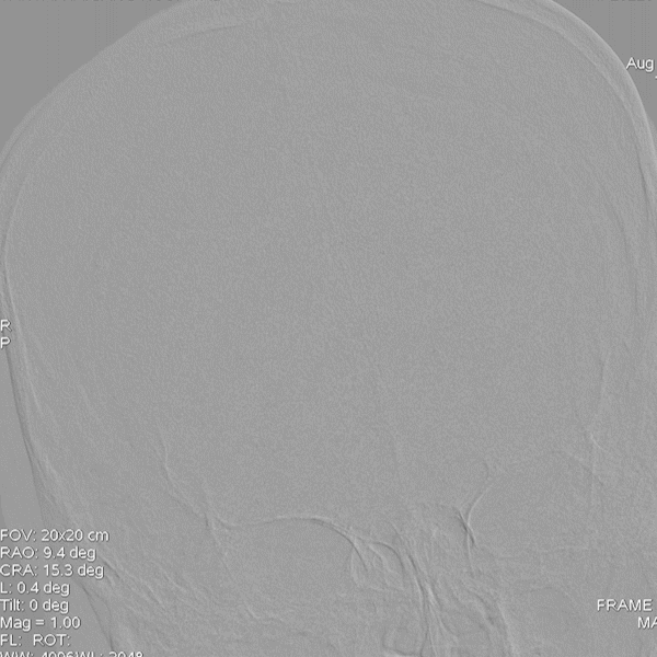 导丝怎么扩【载药时代 球扩天下】NOVA DES®颅内药物洗脱支架在椎动脉颅内段重度狭窄的应用二例_https://www.jmylbn.com_新闻资讯_第27张