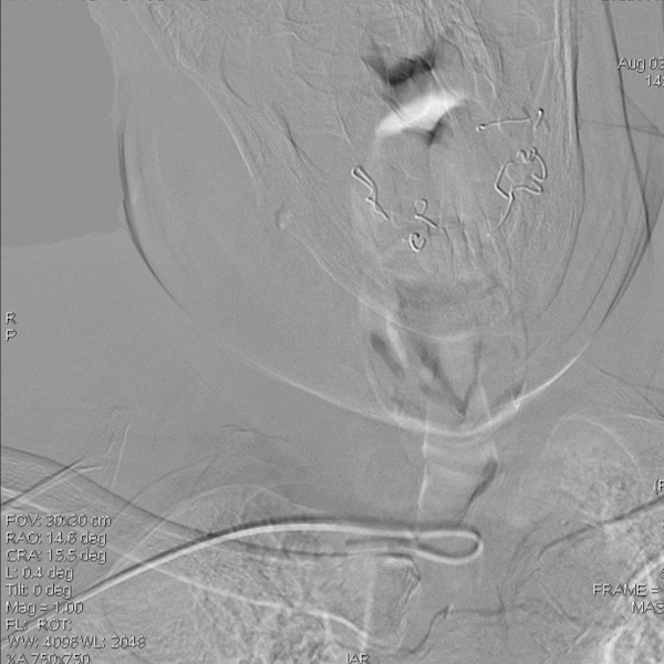 导丝怎么扩【载药时代 球扩天下】NOVA DES®颅内药物洗脱支架在椎动脉颅内段重度狭窄的应用二例_https://www.jmylbn.com_新闻资讯_第24张