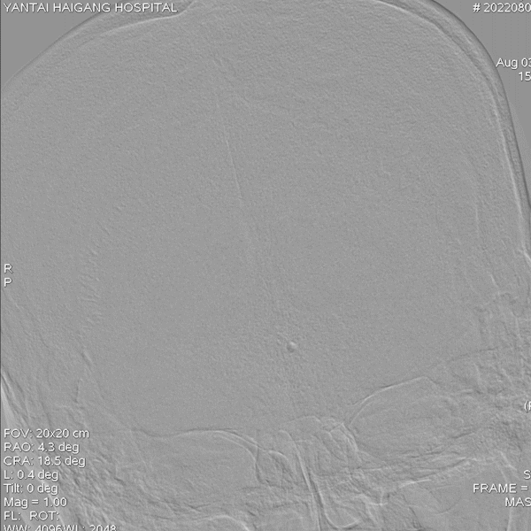 导丝怎么扩【载药时代 球扩天下】NOVA DES®颅内药物洗脱支架在椎动脉颅内段重度狭窄的应用二例_https://www.jmylbn.com_新闻资讯_第22张