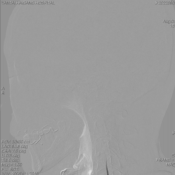 导丝怎么扩【载药时代 球扩天下】NOVA DES®颅内药物洗脱支架在椎动脉颅内段重度狭窄的应用二例_https://www.jmylbn.com_新闻资讯_第26张