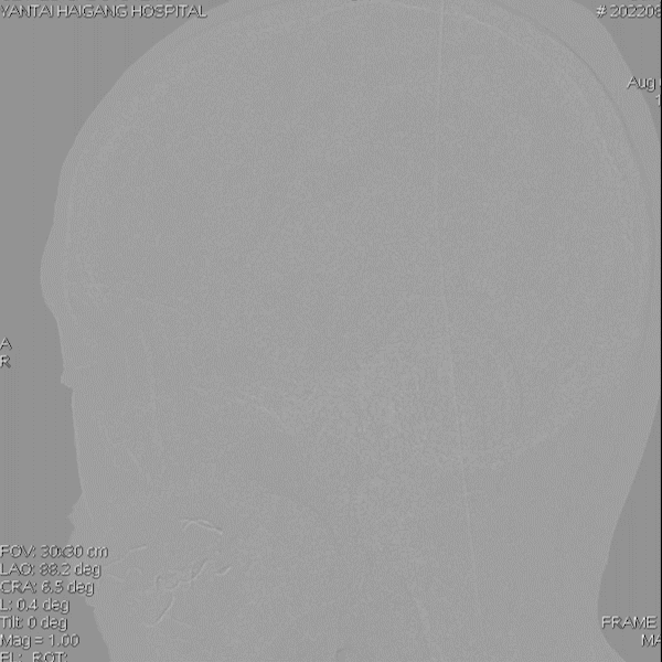 导丝怎么扩【载药时代 球扩天下】NOVA DES®颅内药物洗脱支架在椎动脉颅内段重度狭窄的应用二例_https://www.jmylbn.com_新闻资讯_第28张