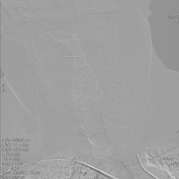 导丝怎么扩【载药时代 球扩天下】NOVA DES®颅内药物洗脱支架在椎动脉颅内段重度狭窄的应用二例_https://www.jmylbn.com_新闻资讯_第21张