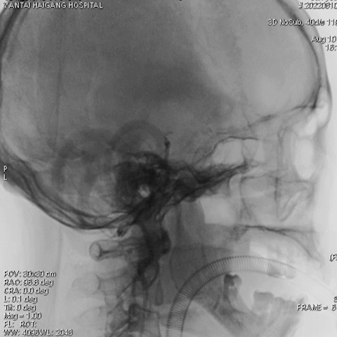 导丝怎么扩【载药时代 球扩天下】NOVA DES®颅内药物洗脱支架在椎动脉颅内段重度狭窄的应用二例_https://www.jmylbn.com_新闻资讯_第32张