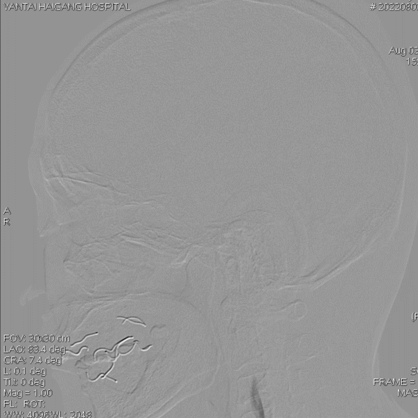 导丝怎么扩【载药时代 球扩天下】NOVA DES®颅内药物洗脱支架在椎动脉颅内段重度狭窄的应用二例_https://www.jmylbn.com_新闻资讯_第23张