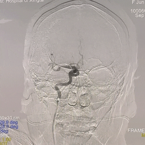 动脉长鞘怎么置入一技之“长”丨经桡及经股困难入路应用赛诺神畅APEX TRA GC™导引导管建立通路病例合集_https://www.jmylbn.com_新闻资讯_第16张