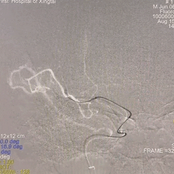 动脉长鞘怎么置入一技之“长”丨经桡及经股困难入路应用赛诺神畅APEX TRA GC™导引导管建立通路病例合集_https://www.jmylbn.com_新闻资讯_第41张