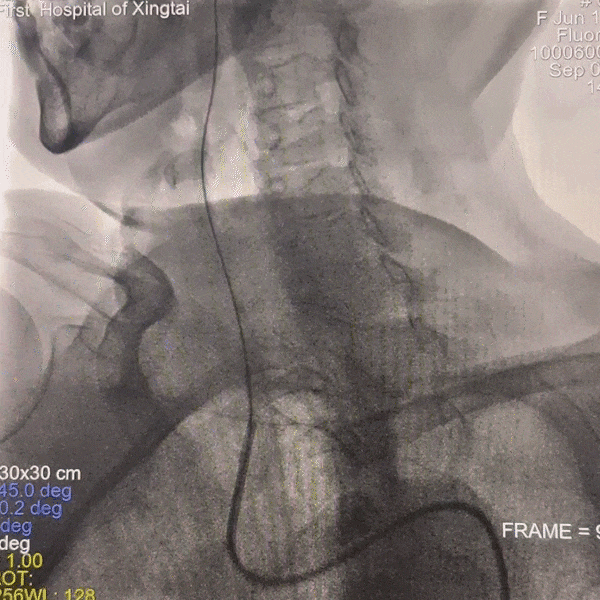 动脉长鞘怎么置入一技之“长”丨经桡及经股困难入路应用赛诺神畅APEX TRA GC™导引导管建立通路病例合集_https://www.jmylbn.com_新闻资讯_第10张