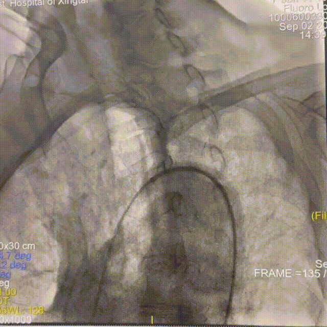 动脉长鞘怎么置入一技之“长”丨经桡及经股困难入路应用赛诺神畅APEX TRA GC™导引导管建立通路病例合集_https://www.jmylbn.com_新闻资讯_第9张