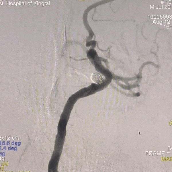 动脉长鞘怎么置入一技之“长”丨经桡及经股困难入路应用赛诺神畅APEX TRA GC™导引导管建立通路病例合集_https://www.jmylbn.com_新闻资讯_第25张