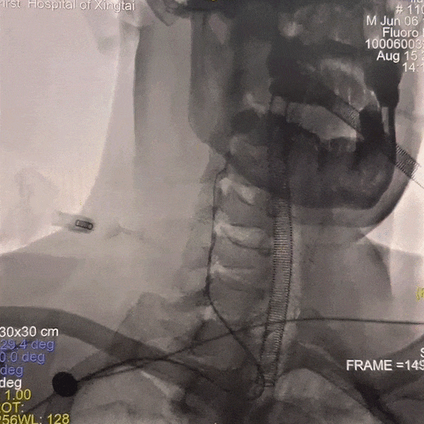 动脉长鞘怎么置入一技之“长”丨经桡及经股困难入路应用赛诺神畅APEX TRA GC™导引导管建立通路病例合集_https://www.jmylbn.com_新闻资讯_第35张