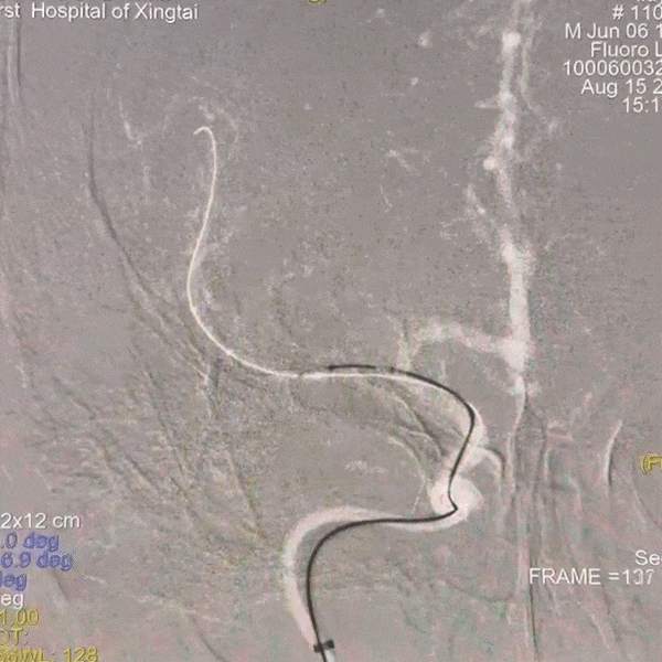 动脉长鞘怎么置入一技之“长”丨经桡及经股困难入路应用赛诺神畅APEX TRA GC™导引导管建立通路病例合集_https://www.jmylbn.com_新闻资讯_第44张