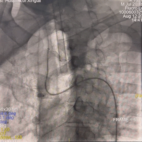动脉长鞘怎么置入一技之“长”丨经桡及经股困难入路应用赛诺神畅APEX TRA GC™导引导管建立通路病例合集_https://www.jmylbn.com_新闻资讯_第23张