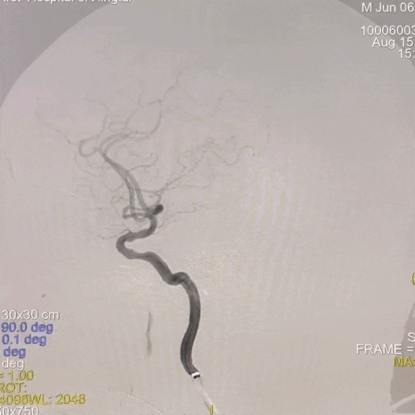 动脉长鞘怎么置入一技之“长”丨经桡及经股困难入路应用赛诺神畅APEX TRA GC™导引导管建立通路病例合集_https://www.jmylbn.com_新闻资讯_第46张