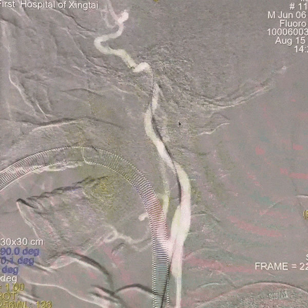 动脉长鞘怎么置入一技之“长”丨经桡及经股困难入路应用赛诺神畅APEX TRA GC™导引导管建立通路病例合集_https://www.jmylbn.com_新闻资讯_第36张