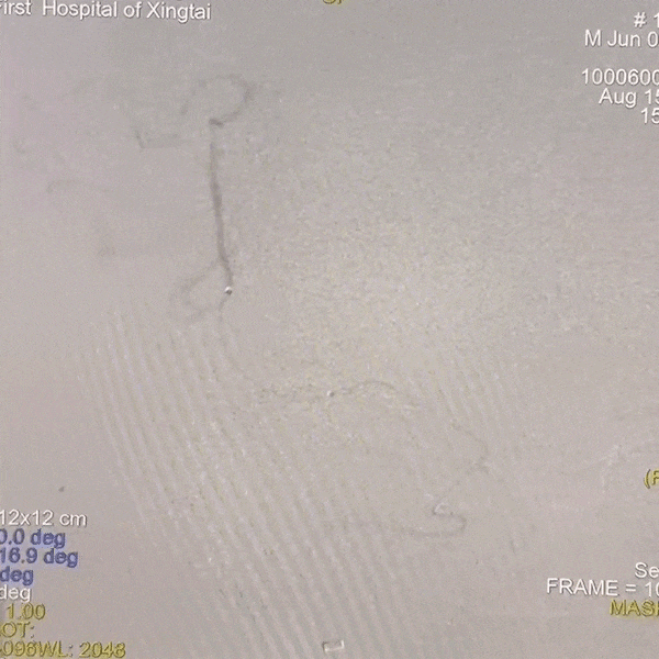 动脉长鞘怎么置入一技之“长”丨经桡及经股困难入路应用赛诺神畅APEX TRA GC™导引导管建立通路病例合集_https://www.jmylbn.com_新闻资讯_第42张