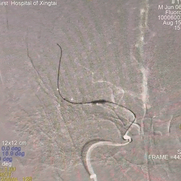 动脉长鞘怎么置入一技之“长”丨经桡及经股困难入路应用赛诺神畅APEX TRA GC™导引导管建立通路病例合集_https://www.jmylbn.com_新闻资讯_第43张