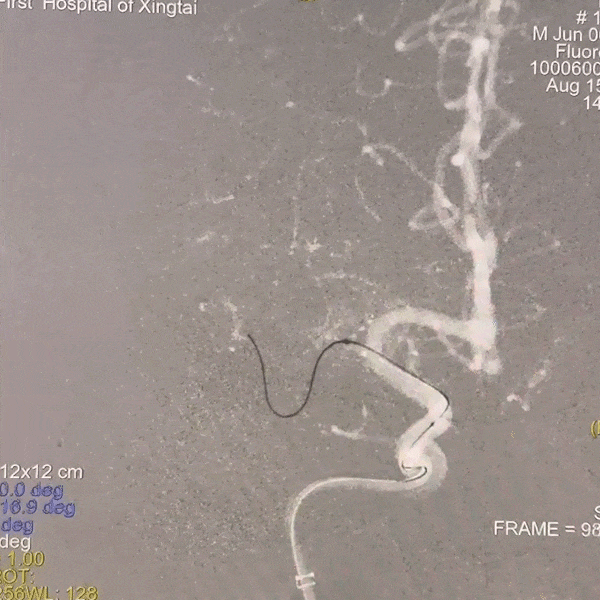 动脉长鞘怎么置入一技之“长”丨经桡及经股困难入路应用赛诺神畅APEX TRA GC™导引导管建立通路病例合集_https://www.jmylbn.com_新闻资讯_第39张