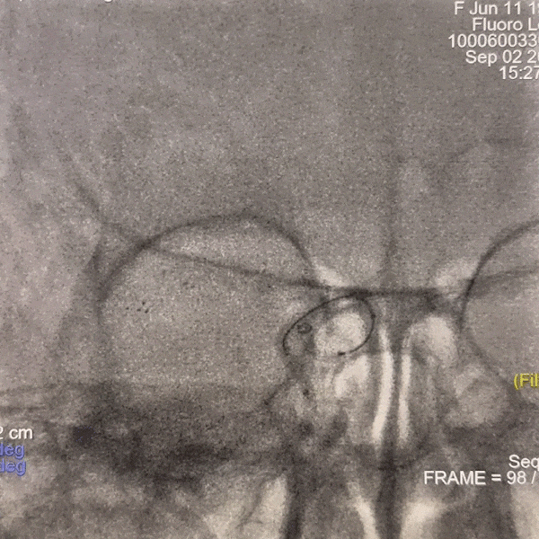 动脉长鞘怎么置入一技之“长”丨经桡及经股困难入路应用赛诺神畅APEX TRA GC™导引导管建立通路病例合集_https://www.jmylbn.com_新闻资讯_第13张
