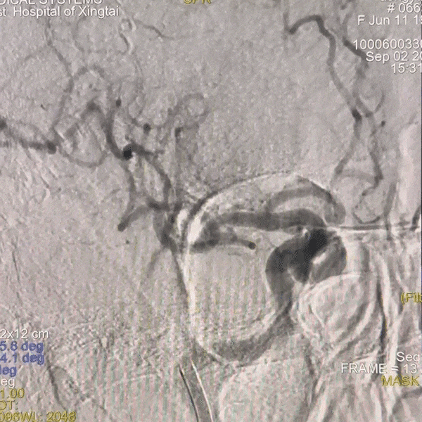 动脉长鞘怎么置入一技之“长”丨经桡及经股困难入路应用赛诺神畅APEX TRA GC™导引导管建立通路病例合集_https://www.jmylbn.com_新闻资讯_第15张