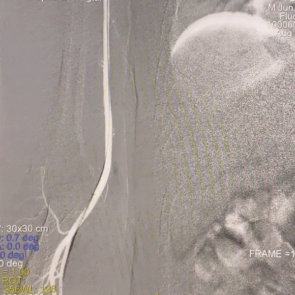 动脉长鞘怎么置入一技之“长”丨经桡及经股困难入路应用赛诺神畅APEX TRA GC™导引导管建立通路病例合集_https://www.jmylbn.com_新闻资讯_第33张