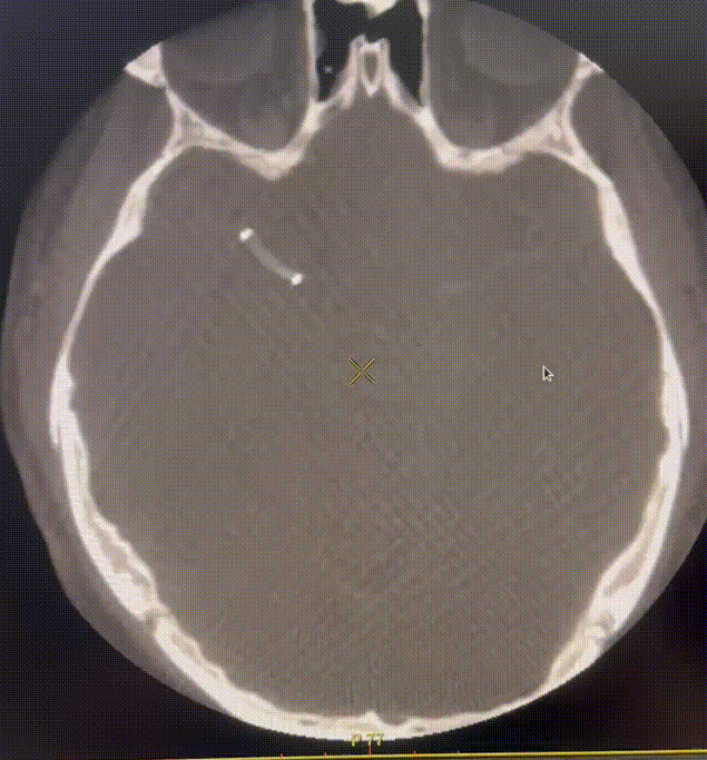 动脉长鞘怎么置入一技之“长”丨经桡及经股困难入路应用赛诺神畅APEX TRA GC™导引导管建立通路病例合集_https://www.jmylbn.com_新闻资讯_第47张