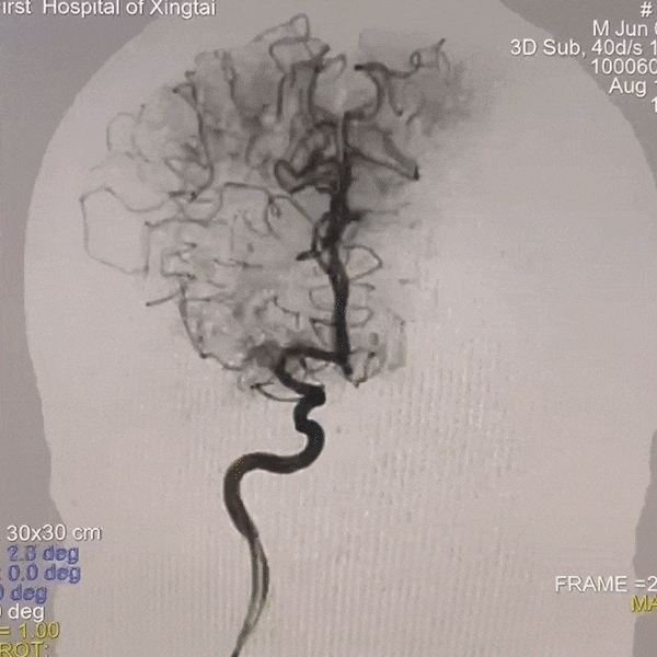 动脉长鞘怎么置入一技之“长”丨经桡及经股困难入路应用赛诺神畅APEX TRA GC™导引导管建立通路病例合集_https://www.jmylbn.com_新闻资讯_第37张